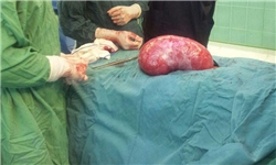 توده ۵ کیلوگرمی با انجام عمل جراحی از بدن بیمار زرندی خارج شد